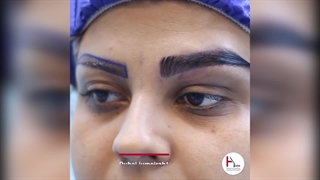 زراعة الحواجب بأحدث تقنیة FUT للجمال الدائم عیادة هیلیا