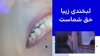 دندانپزشکی دکتر مهسا حیدری رفع افتادگی پلک