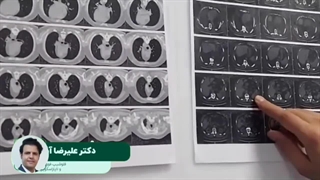 جراحی لاپاراسکوپیک | کیست هیداتید طحال