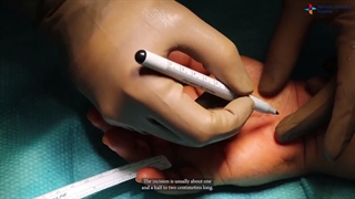 روش جراحی سندروم تونل کارپال