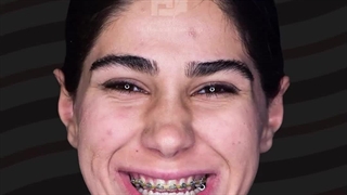 جراحی همزمان فک و چانه در کلینیک دکتر هوشنگی