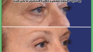 تزریق چربی به پیشانی منافذ باز پوست