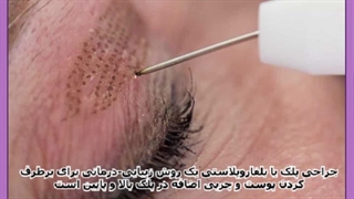 معرفی بهترین روش جراحی بلفاروپلاستی
