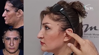 توضیحات دکتر مرادی در مورد جراحی لیفت صورت و جای اسکار آن