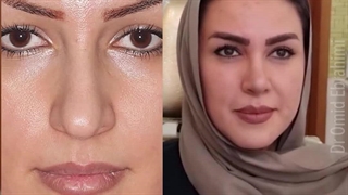 قبل و بعد از جراحی بینی قوزدار | دکتر امید ابراهیمی