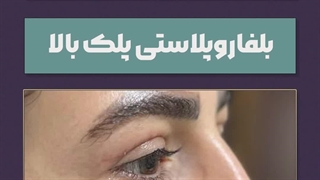 ساخت استوری قبل و بعد