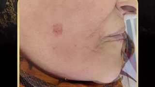 برداشتن خال و زگیل در ارومیه توسط روش پیشرفته RF