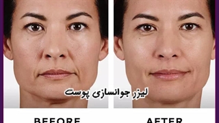 جوانسازی پوست