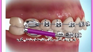 ارتودنسی منافذ باز پوست