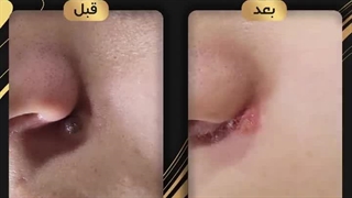 برداشتن خال و زگیل در ارومیه فقط در 1 جلسه و بدون جراحی!