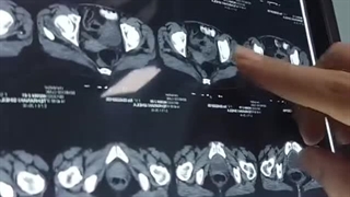 جراحی لاپاراسکوپیک-سرطان سیگمویید با درگیری مثانه