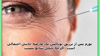 پف چشم بعد از بوتاکس