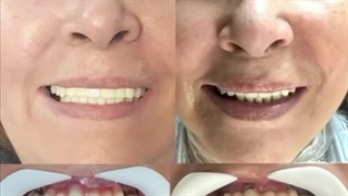 بهترین مرکز ایمپلنت در تهران