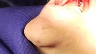 ایمپلنت کار ماهر-5