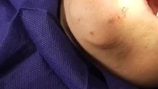 ایمپلنت کار حرفه ای 10