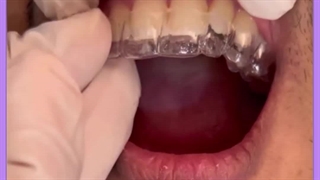 ارتودنسی برداشتن زگیل