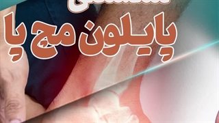 علائم شکستگی پایلون مچ پا