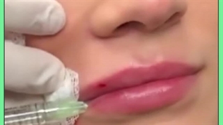 تزریق چربی به لب رفع چین و چروک