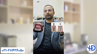 همه دندان‌هامو از دست دادم، ایمپلنت بزارم یا دندان مصنوعی؟