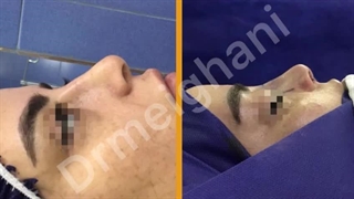 ترمیم بینی دکتر علی میقانی