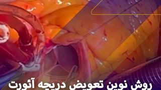 روش نوین تعویض دریچه آئورت به کمک بالون