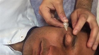 جوانسازی ناحیه دور چشم با دستگاه پزشکی کربوکسی تراپی
