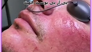 پی آر پی پوست روکش دندان