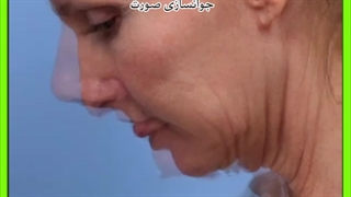 جوانسازی صورت کاشت مو