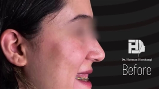 اصلاح لبخند لثه ای