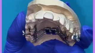 ارتودنسی اکستنشن تاج دندان