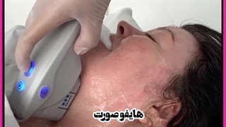 هایفو صورت پیلینگ