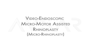 جراحی بینی استخوانی