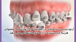 ارتودنسی دندان پیش
