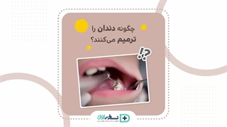 ترمیم دندان- پوسیدگی دندان - داروخانه آنلاین نسخه اول - داروخانه اینترنتی نسخه اول