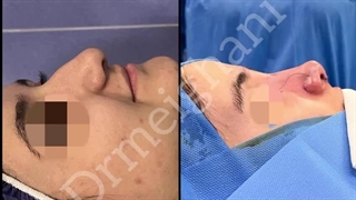 جراحی زیبایی بینی