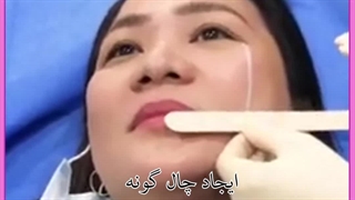 چال گونه لیزر موهای زائد