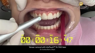 Veneer removal with LiteTouch™ Er:YAG laser