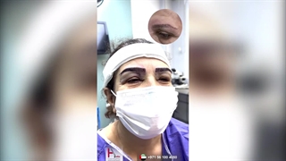 زراعة الحواجب: تجربة ناجحة لزراعة الحواجب