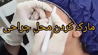 دکتر سارا رفیعی دکتر پوست بندرعباس جراحی پف زیر چشم