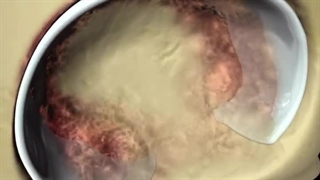 نکات مهم جراحی تعویض مفصل لگن