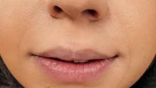 تزریق ژل لب در کلینیک سامان اسکین کرج