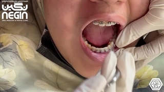 ارتودنسی ثابت دوفک - دکتر نیلوفر آزاده، متخصص ارتودنسی و ناهنجاری های فک