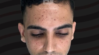 قبل و بعد از جراحی بینی توسط دکتر هوشنگی