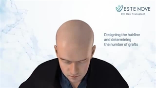 کاشت مو به روش DHI