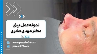 دکتر مهدی صابری بهترین جراح بینی تهران برداشتن توده