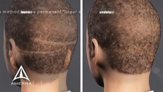 توضیح کاشت مو با روش‌های FIT و FUT پریودنتیکس