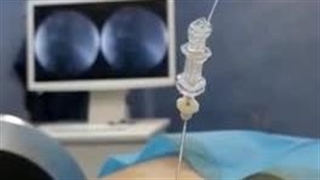 عمل لیزری دیسک در چند ثانیه. دکتر علی نمازی جراح ستون فقرات کلینیک درد مهرگان لیفت پیشانی