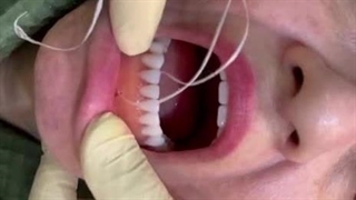 فیلم ریتنشن فک پایین کلینیک تخصصی دندان مصنوعی مستر دندان