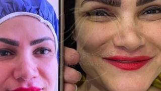 عمل جراحی بلفاروپلاستی