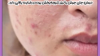 درمان جای جوش پیلینگ